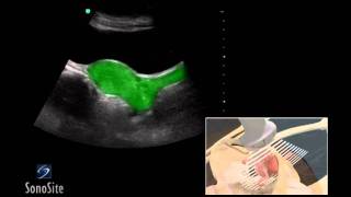 How to Cardiac Ultrasound  Apical View Case Study [upl. by Dnomso]