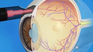 CPC for Glaucoma Treatment [upl. by Marbut]