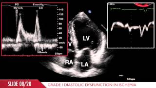 Acute Myocardial Infarction [upl. by Hashimoto]