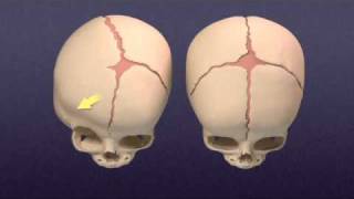 UrsachenBehandlungen Intercostalneuralgie [upl. by Jordans]