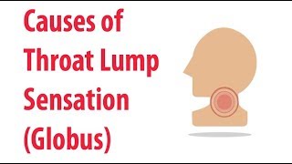 Causes of Throat Lump Sensation Globus [upl. by Elfie]