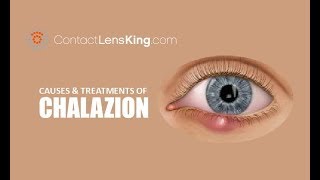 Chalazion  Causes Treatment and Surgery [upl. by Omer]