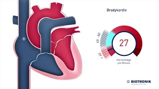 Langsame Herzrhythmusstörungen Bradykardie [upl. by Suirtemed]