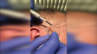 Seborrhoeic Keratosis Removal Demo [upl. by Anirt852]