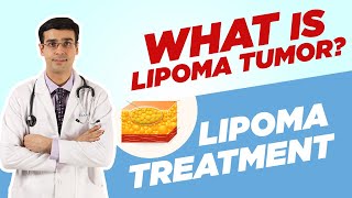 Whats a LIPOMA TUMOR  How Lipoma can be Treated  Dr Anirudh Vij [upl. by Anned438]