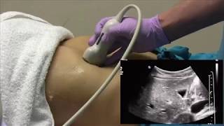 How I do it Ultrasound of the Abdomen [upl. by Kassity29]