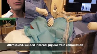 Inferior Vena Cava Filter Placement [upl. by Aniram960]