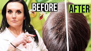 Top 5 Home Remedies To Get Rid Of Head LICE amp Nits  Sushmitas Diaries [upl. by Nnylrats]