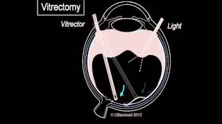 Vitreous 3 Vitrectomy Surgery [upl. by Ainelec]