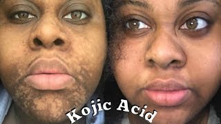 4 MONTHS KOJIC ACID EXPERIENCE \\ Sherelle Saint Rose [upl. by Lamrert540]