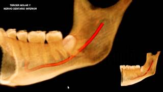 TERCER MOLAR Y CONDUCTO DENTARIO INFERIOR Tomografía Cone Beam [upl. by Drofkcor961]