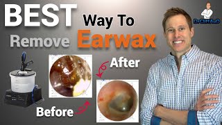 The BEST Way to Professionally Remove Earwax  Earigator Cerumen Irrigation [upl. by Shell]