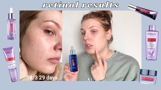 Over 30 Days Of Retinol LOréal Revitalift Skincare Review [upl. by Robinette]