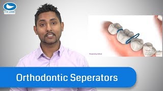 Orthodontic SeparatorsSpacers  What they are and TIPS [upl. by Witte132]