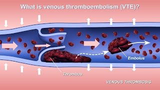 What is a coronary angiogram [upl. by Archibold]