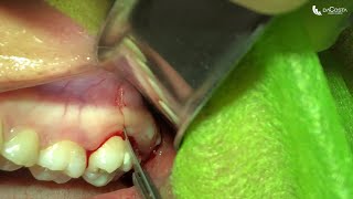 Exodontia de terceiro molar superior Upper wisdom tooth extraction [upl. by Hiltan]