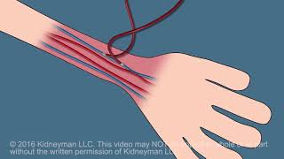 Dialysis Fistula animation [upl. by Felizio118]