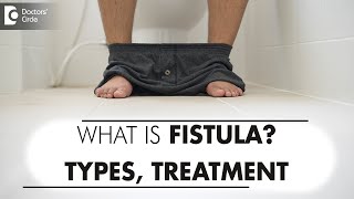 FISTULA ANIMATION  Fistula Types  Treatment Surgery amp LaserDr Rajasekhar M R  Doctors Circle [upl. by Ahsilem]