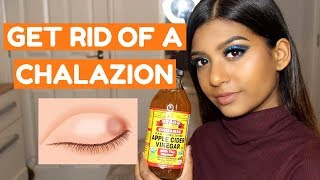 HOW TO GET RID OF A CHALAZION FAST AT HOME [upl. by Alvin]