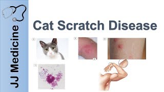 Cat Scratch Disease  Causes Symptoms and Treatment [upl. by Secnarf769]