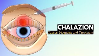 CHALAZION Causes Signs and Symptoms Diagnosis and Treatment [upl. by Tesler]