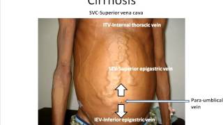 Interpreting abdominal wall veins [upl. by Aicnilav]