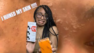 KOJIC ACID SOAP RUINED MY SKIN   WITH PHOTOS  FAIL  Kojie San Skin Lightening Soap [upl. by Camilia]