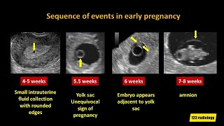 Early Pregnancy Failure A simplified Ultrasound Approach [upl. by Cristy366]