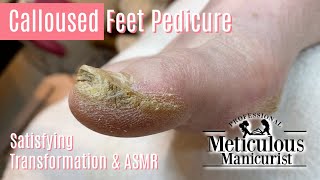 How to Pedicure Extremely Calloused Feet and Toes ASMR [upl. by Etaner]