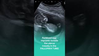 Ectopic Pregnancy I Geeta Hospital I Faridabad [upl. by Bracci621]