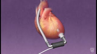 Mayo Clinic Minute How ventricular assist devices can help heart patients [upl. by Blancha]