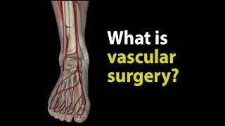 What is vascular surgery [upl. by Keppel]