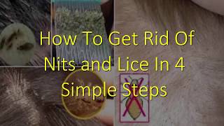 How to remove head lice on kids hair [upl. by Tiernan]