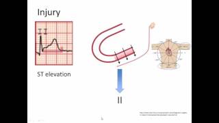 Ischemia Injury and Infarct [upl. by Avirt]