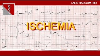 ECG Ischemia [upl. by Atiuqer]