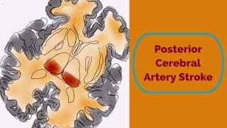 Posterior Cerebral Artery Stroke [upl. by Hsiwhem811]