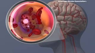 Ischemic Stroke Animation [upl. by Araccot]