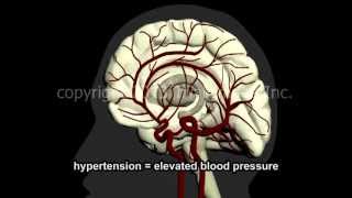 Stroke CVA Cerebrovascular Accident Hemorrhagic Ischemic NCLEX RN amp LPN NURSING [upl. by Oiramaj29]