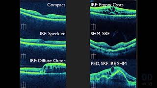 Macular OCT Interpretation A Practical Discussion with Dr David E Lederer [upl. by Strader]