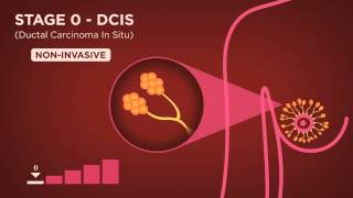 Staging cancers TNM and IIV systems [upl. by Angy416]