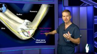 Cubital Tunnel Surgery [upl. by Montagna]