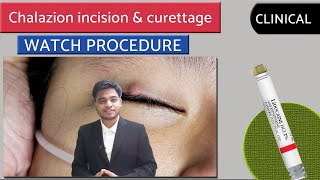 CHALAZION  Chalazion Excision  INCISION amp CURETTAGE  surgery video  opthalmology [upl. by Adrahs]