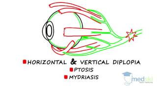 Ophthalmology – Diplopia By Martin ten Hove MD [upl. by Gladdie]