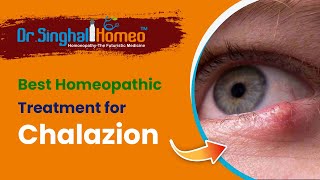 Best Homeopathic Treatment for Chalazion  Dr Singhal Homeo [upl. by Illa221]