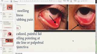 Hordeolum AND CHALAZION [upl. by Rhoads]