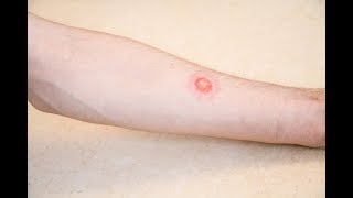 Is it ringworm Signs and symptoms [upl. by Oaks]