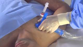 Part 2 Axotrack Tips  Subclavian Vein Central Venous Access [upl. by Gav]